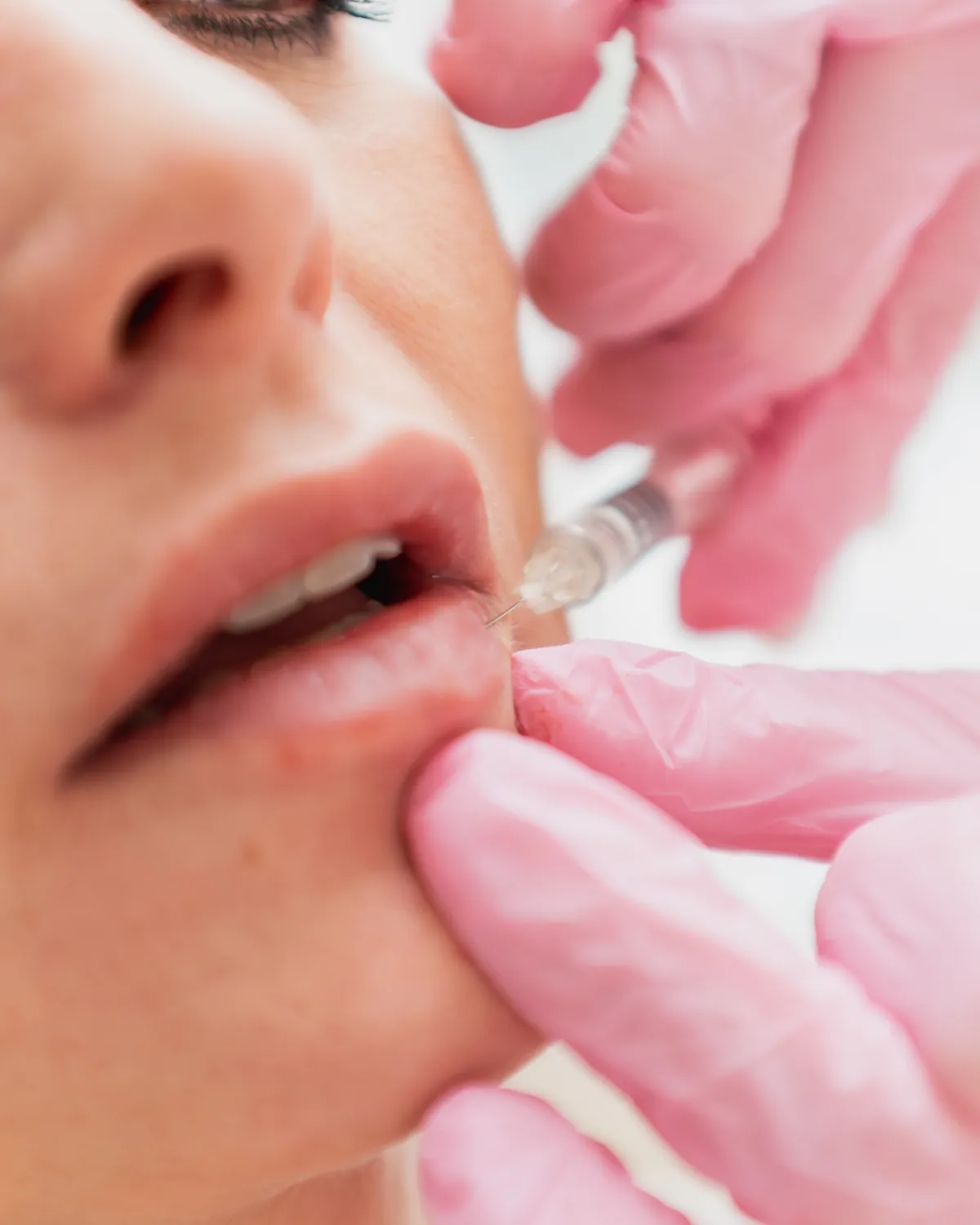 Hyaluronsäure in Wien – Dr. Nicole Egger